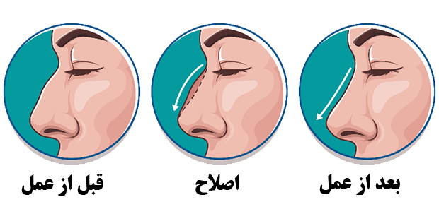 مراحل عمل بینی